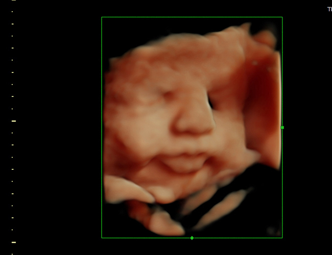 3d sonogram image at HD weeks