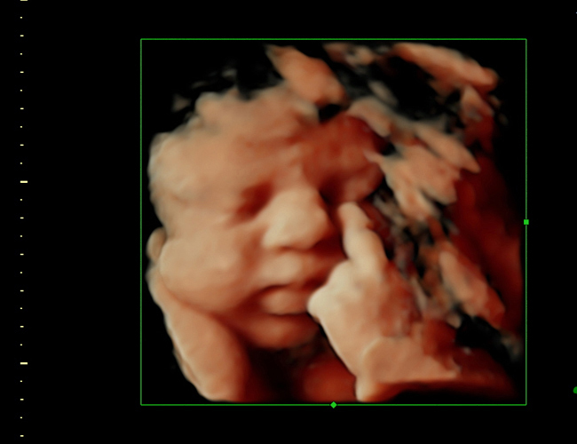 3d sonogram image at HD weeks